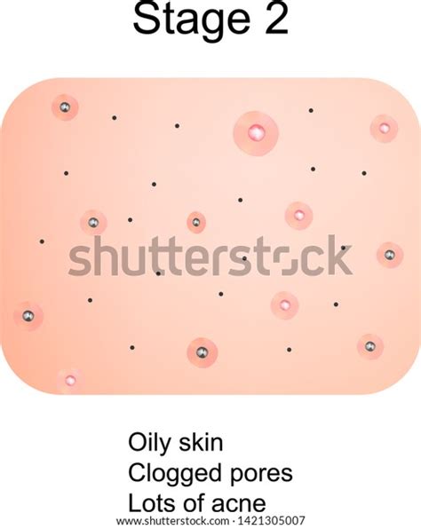 Stage 2 Development Acne Inflamed Skin Stock Vector Royalty Free