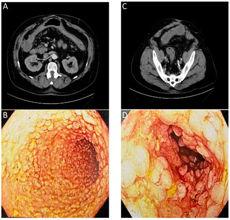 Images Of A Patient With History Of Chronic Diarrhea That Is