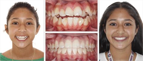 Before And After Hodges Hodges Orthodontics Amarillo Canyon