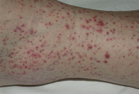 Study Medical Photos A Case Of Purpura