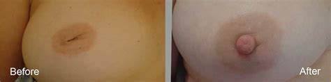 Inverted Nipple Maktare Cosmetic Surgeon In Essex