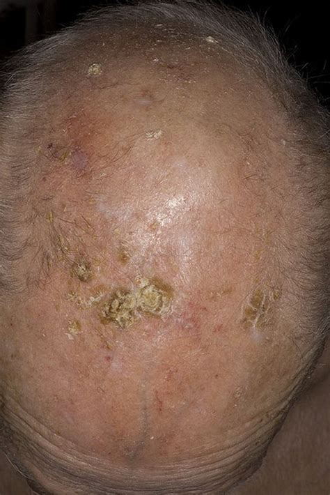 Kinds Of Skin Cancer Types Skin Cancer On Scalp Pictures Photos Images Illnessee Com