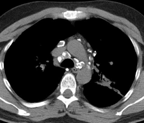 Differential Diagnosis Calcified Mediastinal Nodes Lungs