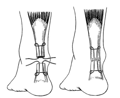 Achilles Tendon Surgery New Health Advisor