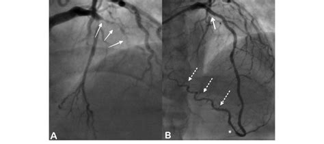 A Cag Revealed Critical Stenosis Of The Proximal Lad With Timi I Flow