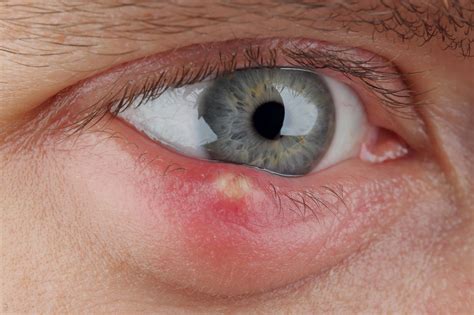 What Is Chalazion How Is It Treated Dr David Woo