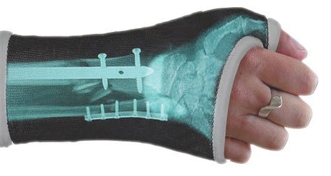 Custom Casts Let You Pimp Your Broken Bones Wired