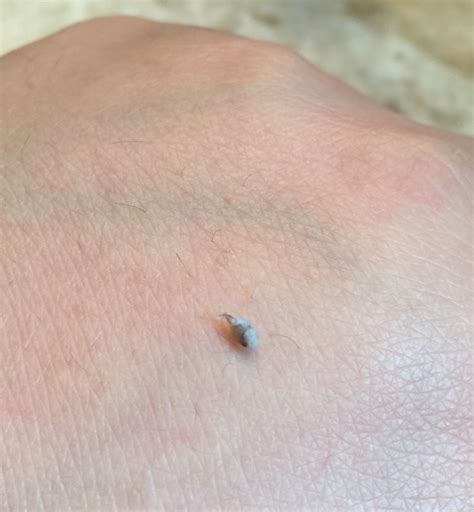 Saw A Bump On My Armpit And Pressed On It This Came Out What Is This
