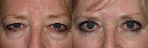 Upper Blepharoplasty Eyelid Lift Pictures 4 Dr Guy Massry