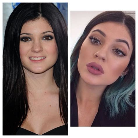 Kylie Jenner Before And After Im Pining This Only Because It Freaks