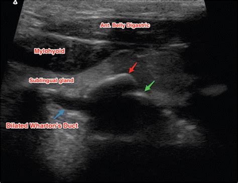 Ultrasound Of The Right Submandibularfloor Of The Mouth Region