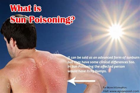 What To Do If You Have Sun Poisoning