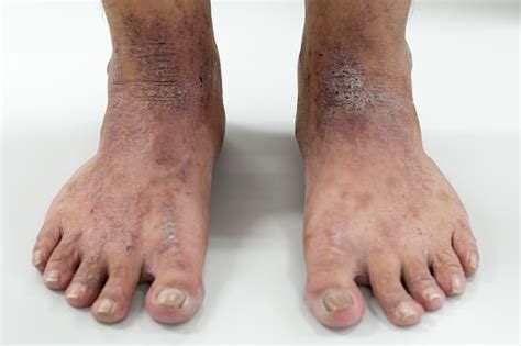 Dermatitis Atópica En Pie Foto De Stock Y Más Banco De Imágenes De