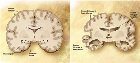 Filealzheimers Disease Brain Comparison Wikimedia Commons