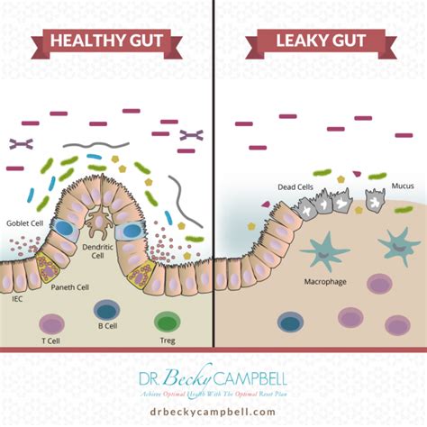 Leaky Gut Healthy Gut Infographic Dr Becky Campbell