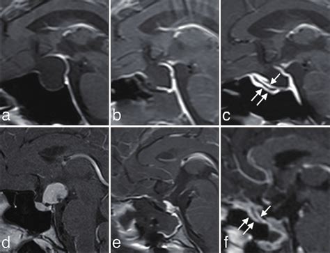 Preoperative And Postoperative Gadolinium Enhanced T1 Weighted Sagittal