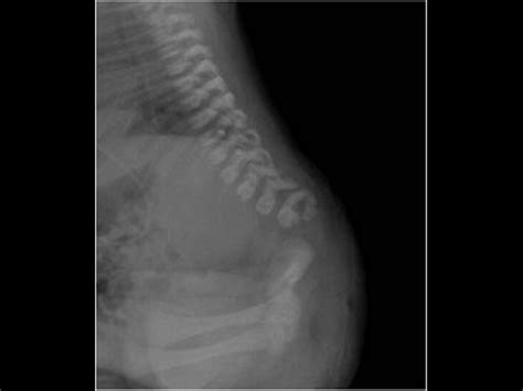 Pediatrics 96 Neonatal Brain And Spine Case 968 Neonatal Spine