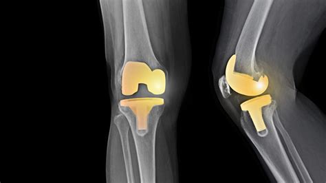 Knee Replacement Surgery Risks And What To Expect