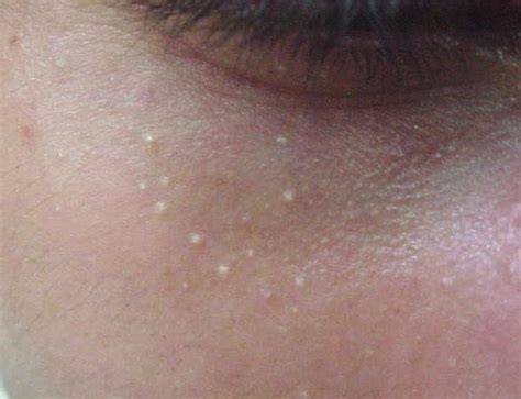 Milia Under Eyes Treatment To Get Rid Of Milia Advanced Skin Therapy