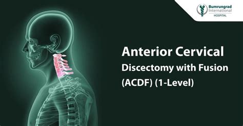 Anterior Cervical Discectomy With Fusion 1 Level Acdf Cervical