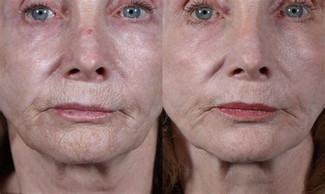 Remove Lip Line Wrinkles With Plasma Pen By Dr John Hilinski In San