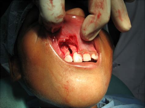 Management of dens in dente associated with a chronic periapical lesion ...