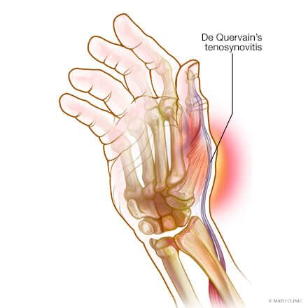 Flexor carpi radialis tendonitis is an example of flexion. DeQuervain's tenosynovitis - Sports Medicine