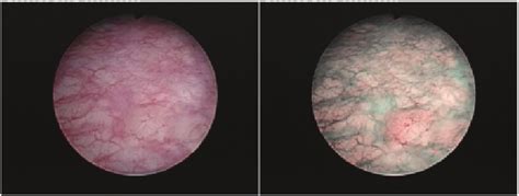 Information about using the images in this summary. Carcinoma in situ lesion missed during standard cystoscopy ...
