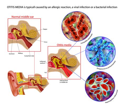 Otitis Media With Effusion Article Statpearls