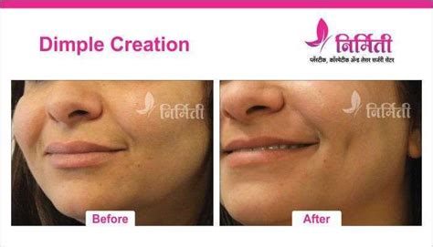 Dazzling Dimple Creation Surgery By Expert Surgeon