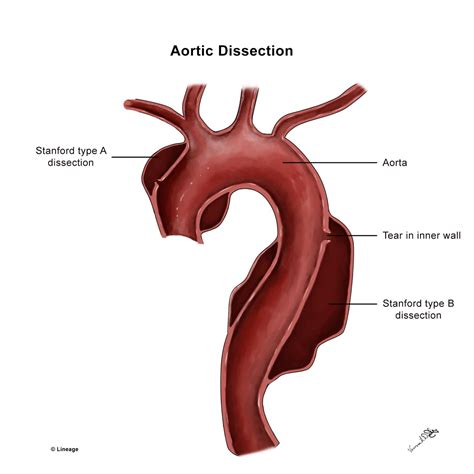 Aortic Dissection Cardiovascular Medbullets Step 42624 The Best Porn
