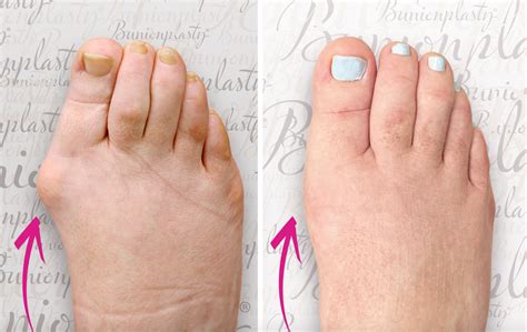 Can I Get Bunion Surgery Without Noticeable Scars Dr Blitz