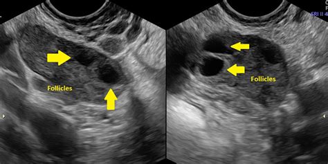 What Is Polycystic Ovarian Syndrome The Ultrasound Suitethe