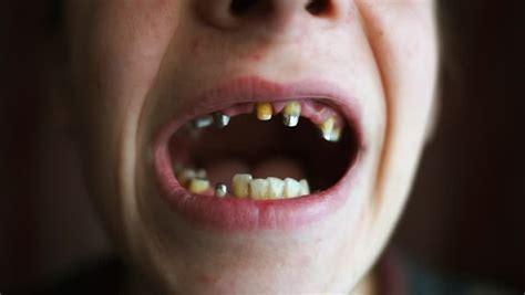 Man Bad Teeth Shows His Rotten Stock Footage Video 100 Royalty Free