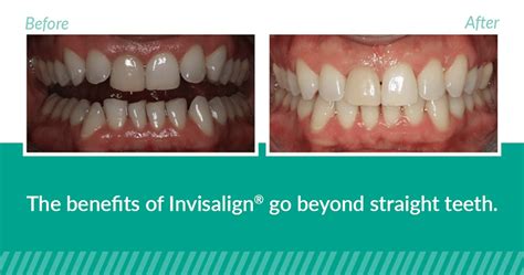 Check Out This Invisalign Before And After Transformation Smile Ballard