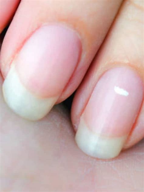 White Spots On Fingernails Heres What It Means The Financial Express