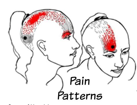 Cluster Headaches Migraine Headaches Headache Types Acupuncture