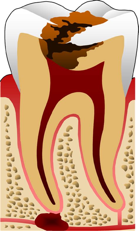 Menggosok gigi dengan keras akan menyebabkan gusi surut dan gigi menjadi sensitive. Cara Menggosok Gigi Yang Betul