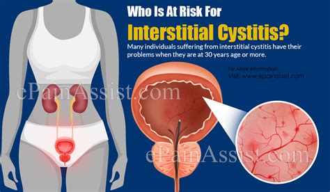 Who Is At Risk For Interstitial Cystitis Is There A Blood Test For It