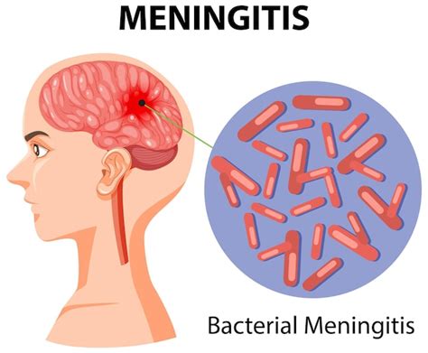 Meningitis Images Free Download On Freepik
