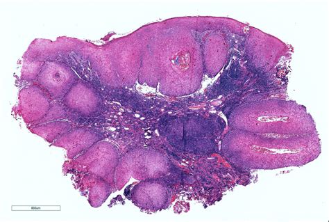 73 Verrucous Carcinoma Of Vulva Image Courtesy Of Dr Flickr