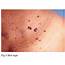 Benign Skin Tumours  NSC