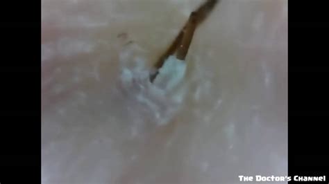 Ingrown Hair Pull Out Hair Follicles Close Up Part 1 Youtube