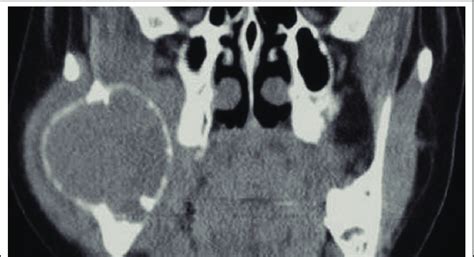 Aneurysmal Bone Cyst Of Mandible Download Scientific Diagram