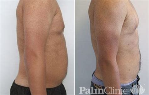 Male Love Handles Liposuction Before And After Photos Palm Clinic