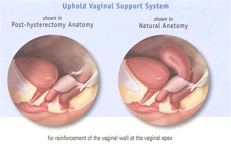 Pelvic Floor Prolapse Surgery Recovery Review Home Co