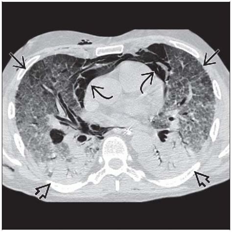 Noncardiogenic Pulmonary Edema Radiology Key