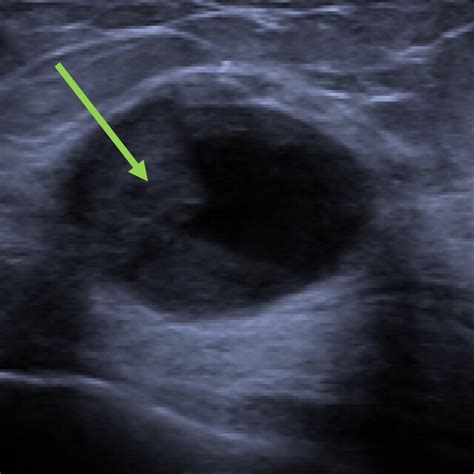 Ultrasound Image Showing A Complex Solid‐cystic Mass Containing An