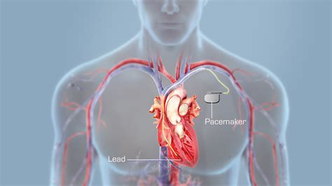 All You Need To Know About Pacemakers Scientific Animations