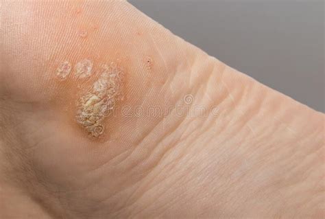 Plantar Wart On Big Toe Visible Black Dots Warts Stock Image Image